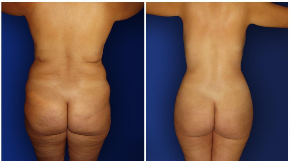 0-march-tummytuck-3